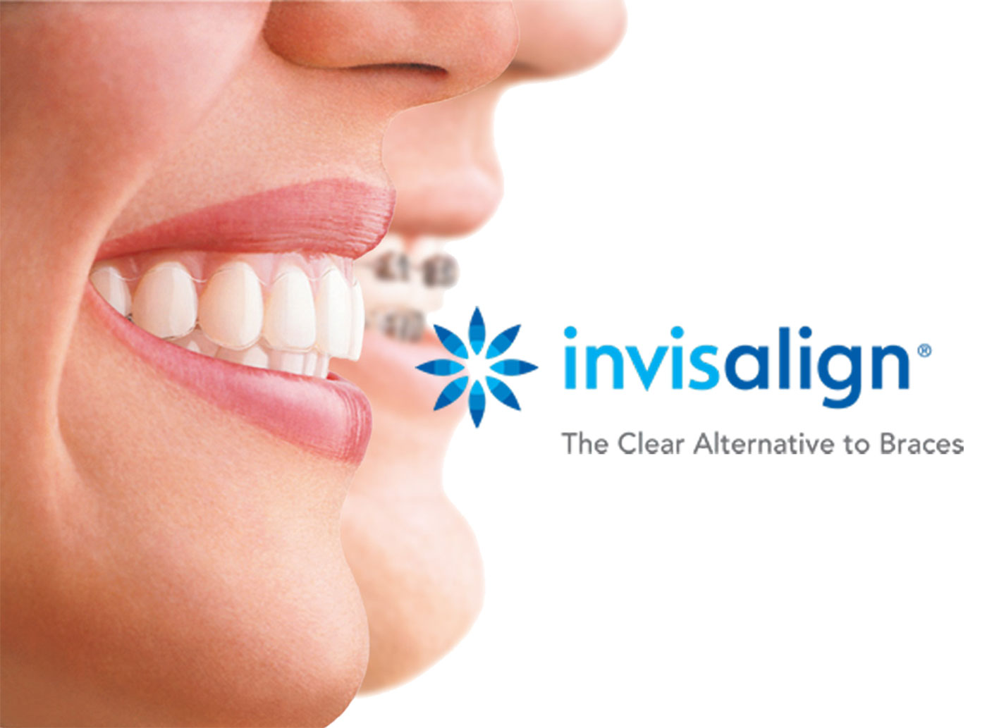 Invisalign Image