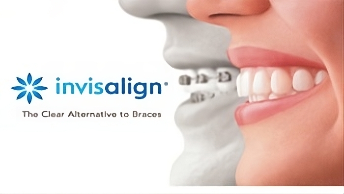 יישור שיניים בשיטת Invisalign הוא פתרון בלתי נראה ומתקדם לאיזון השיניים שלך. מושלם לילדים ומבוגרים